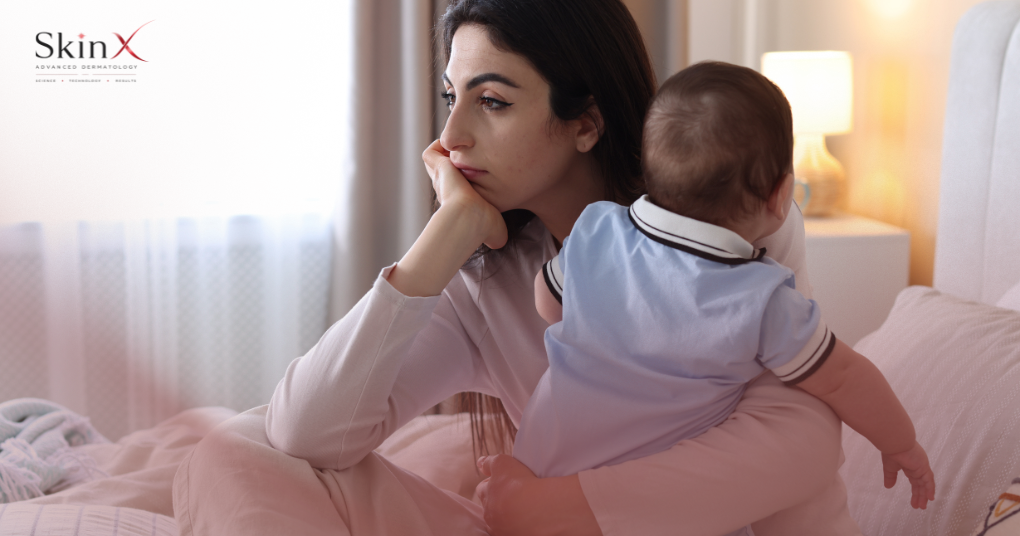Mụn nội tiết sau sinh: Nguyên nhân và cách điều trị